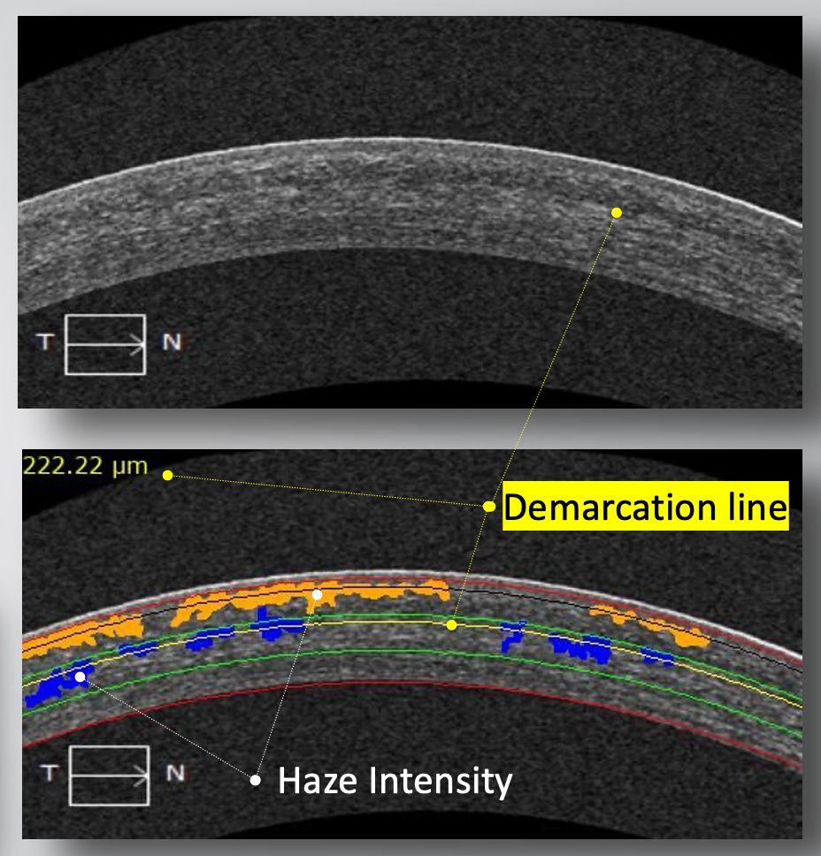 OCT Analysis | NeuralVision